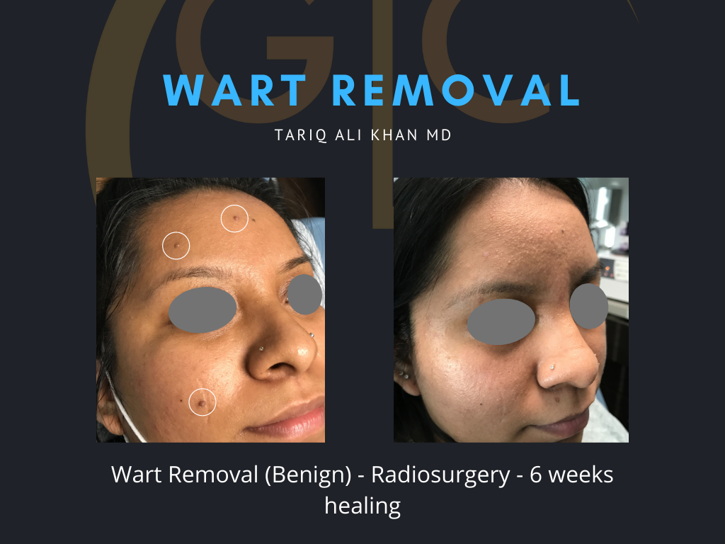 Gentle Care Laser Tustin Before and After picture - Wart Removal